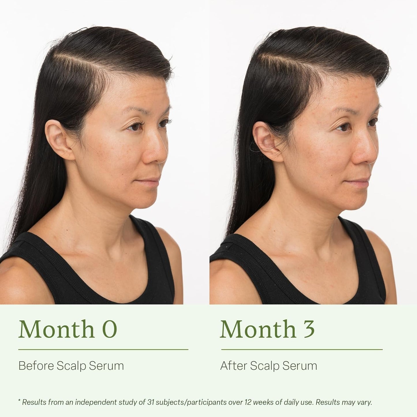🧡🧡Final 4 Hours: 60% OFF Scalp Serum, Clinically Tested Hair Growth Formula, for Fuller and Thicker Hair