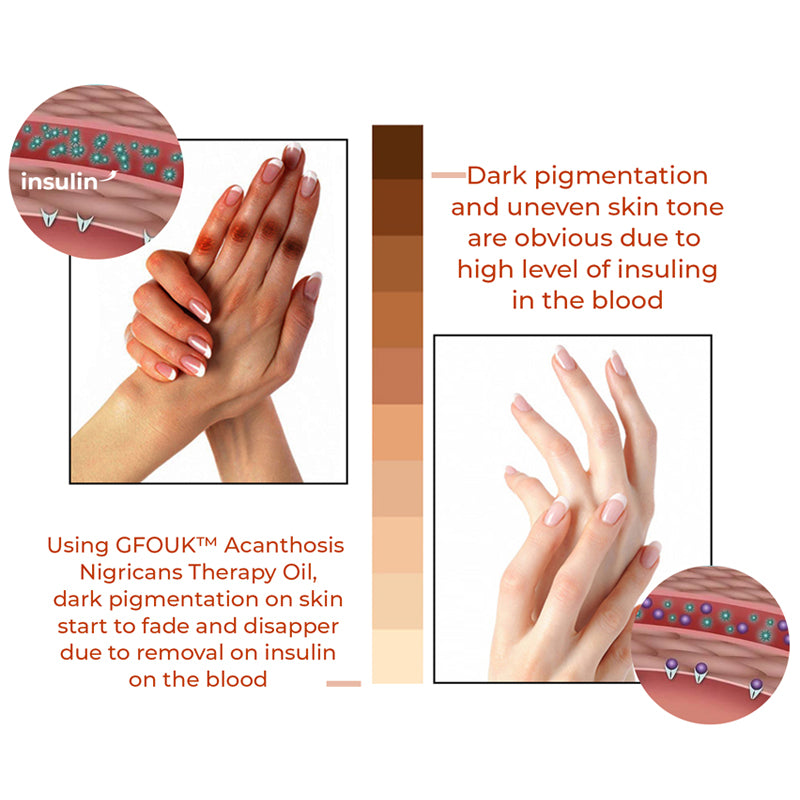 Ziprino® Acanthosis Nigricans Therapy Oil ✨ Approved by American Academy of Dermatology